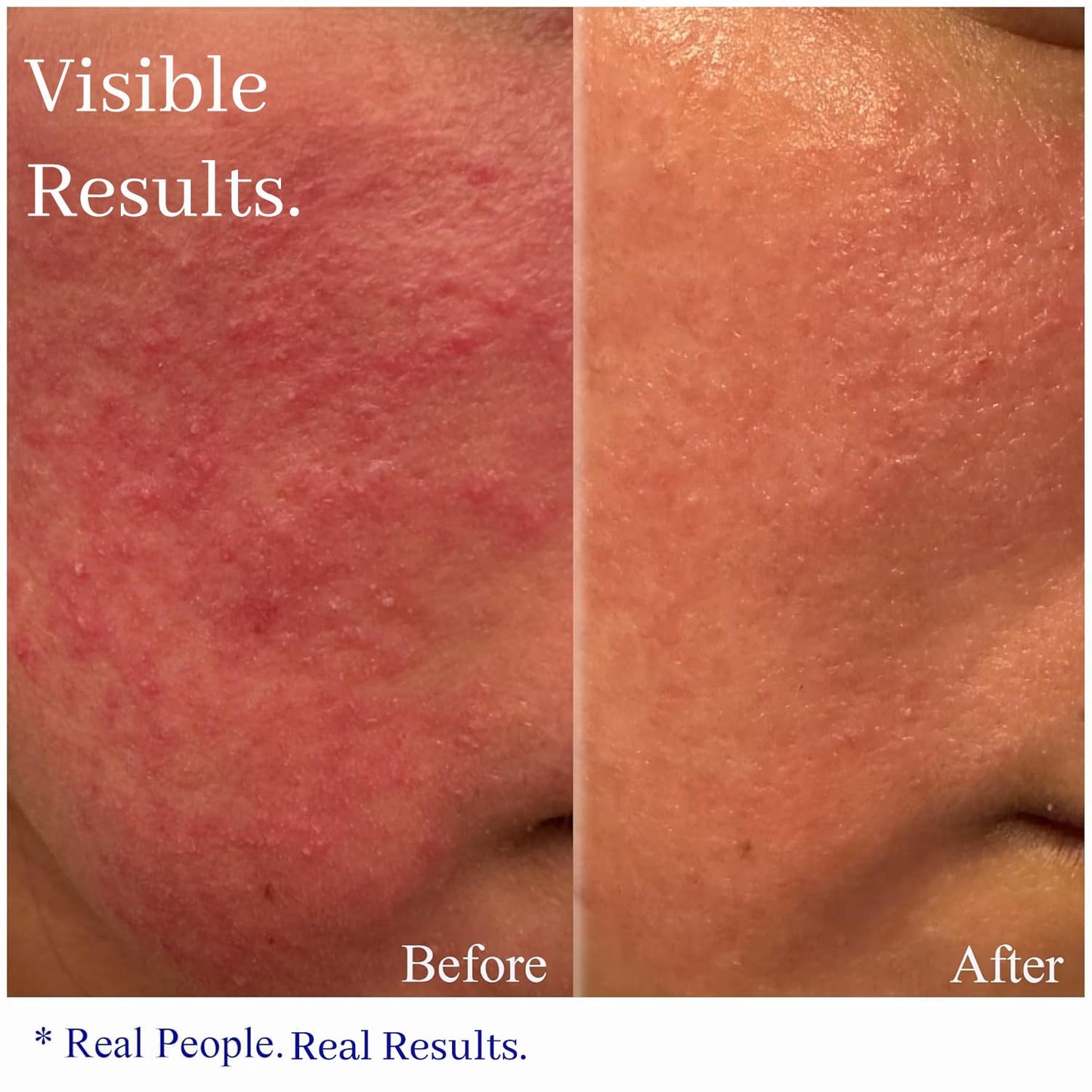 Hey Honey Skincare Relax, Instant Rosacea Treatment & Face Redness Relief - Dermatologically Tested Calming Moisturizer for Sensitive Skin Oil- Free with Honey & Propolis Anti-Aging Benefits | 2.2 Oz